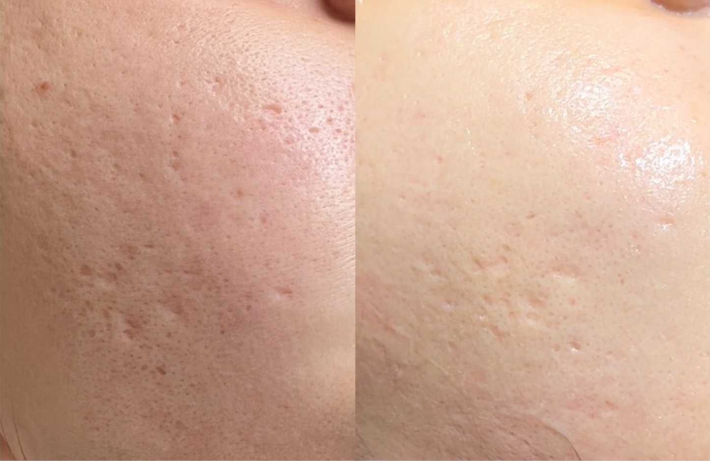 Før og efter to microneedlingbehandlinger af ar og hudstruktur i ansigtet