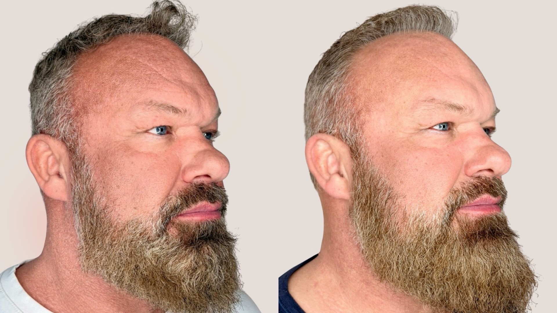 Før og efter kombineret forløb med Botox, Vitaran og filler