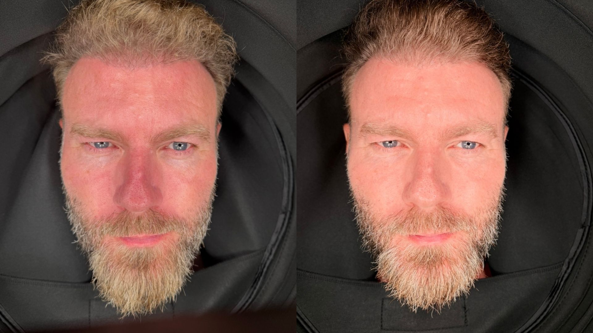 SkinScope før og efter et individuelt hudforløb med hjemmepleje og to microneedlingbehandlinger